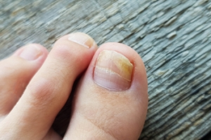 Symptoms of Toenail Fungus