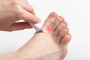 Causes and Symptoms of Athlete&#039;s Foot
