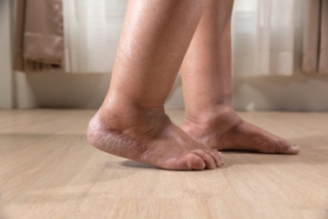 Common Reasons for Swollen Feet